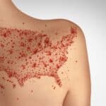 Canada's Measles-Free Status Ends After Nearly 30 Years Amid U.S. Risks