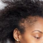 Experts Warn of Rising Temple Thinning and Offer Effective Solutions