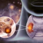 Thyroid Cancer Rates Surge Among Young Women, Raising Urgent Health Concerns